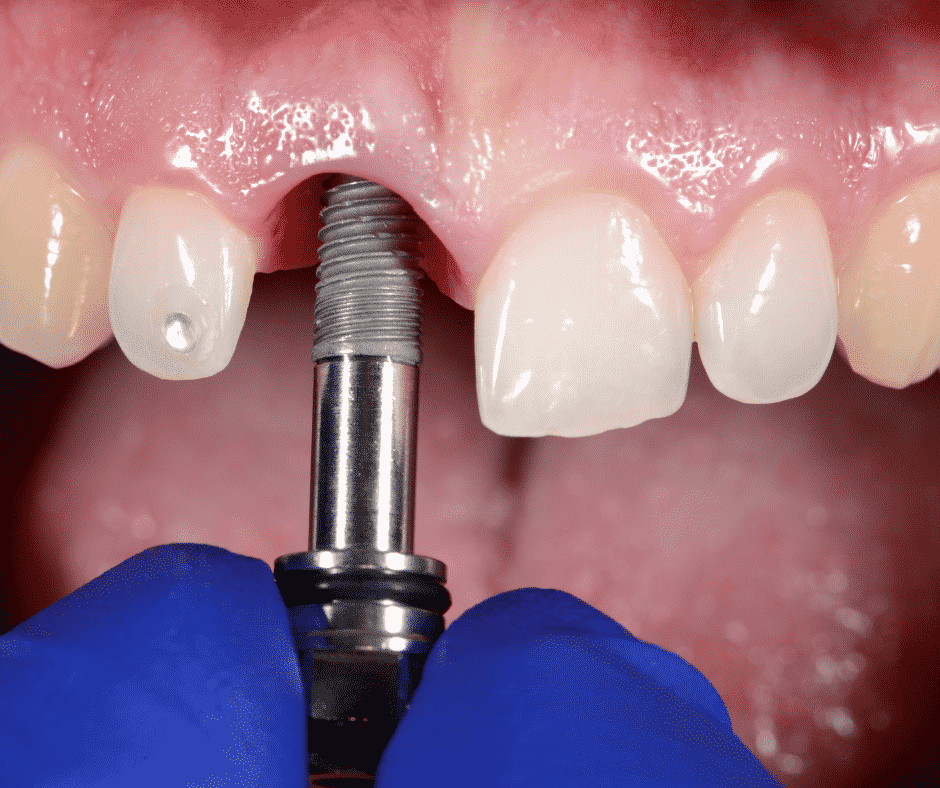 Does Medicare Cover Dental Implants For Seniors?