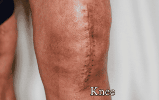 Knee replacement on Medicare